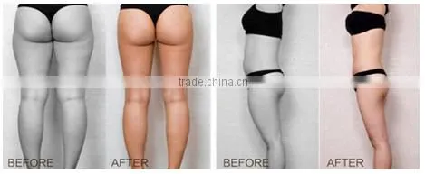 HIFU ultrasound technology resolve fat sells with training video