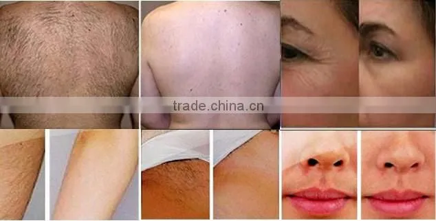 CE Certificated Fast hair removal IPL diode laser wrinkle and ance removal with teaching video