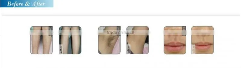 808nm diode laser hair removal machine no harm to skin/ no side-effect