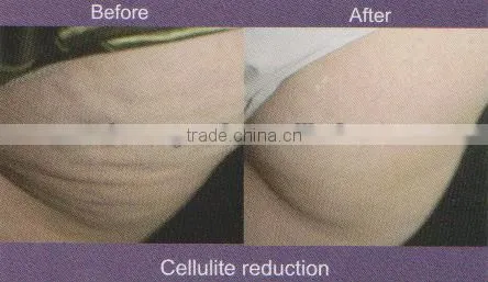 Slimming Machine Ultrasonic Liposuction Equipment