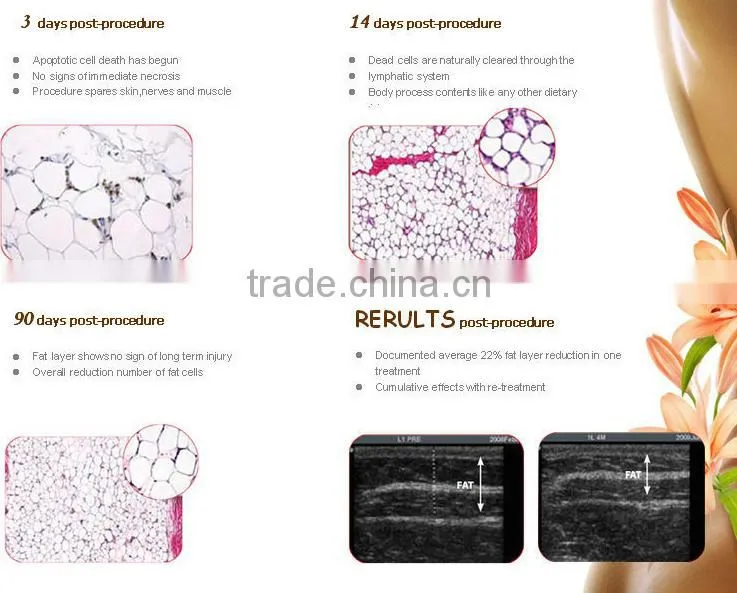 lipo freeze treatment coolsculption areas/ non surgical belly fat removal