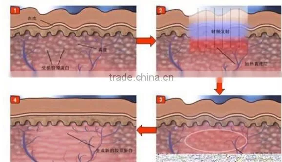 High effective multifunction cryo rf system freeze fat laser beauty equipment