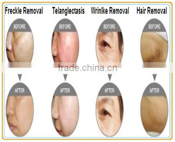 new SHR global IPL/chin hair removal /new opt shr