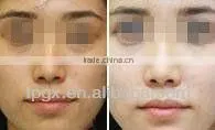 2013 high-power ND Qswitced Yag Laser E-light and RF 3 in 1 hair removal Machine