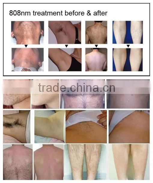 Professional permanent hair removal for men