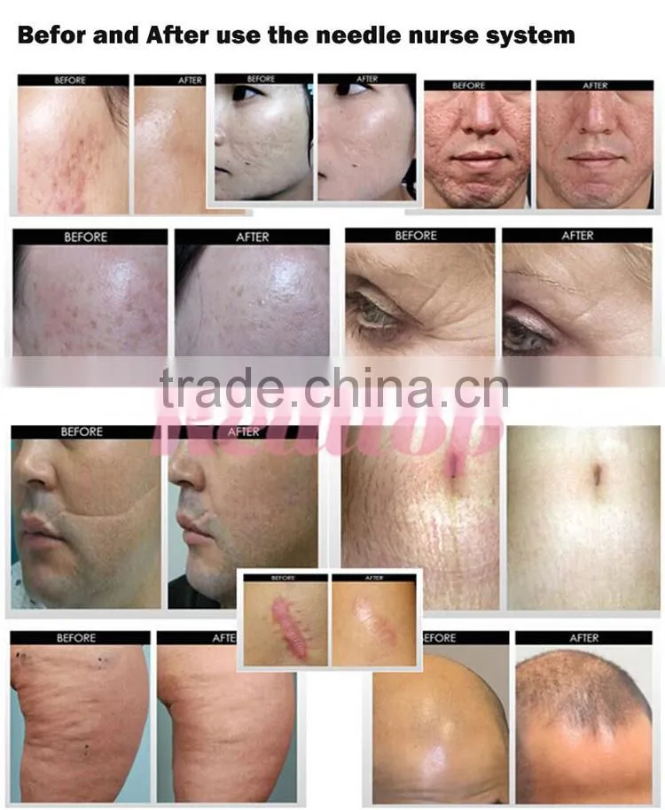 Realtop medical grade dermaroller derma roller 540 microneedling pen / meso needles for skin whitening pigment removal