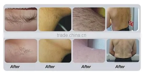 Painless no side-effect diode hair removal laser machine