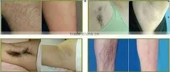 The factory low price promotions! Professional diode laser/808nm diode laser/laser hair removal for permanent hair removal