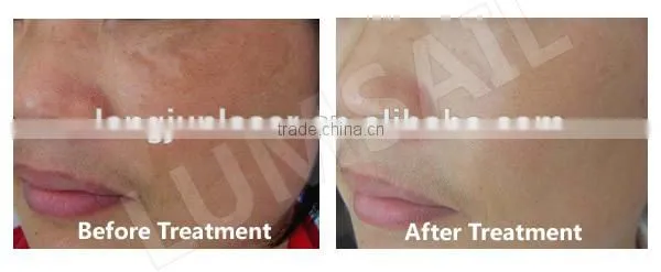 Colorful LED Phototherapy Light Therapy Facial Skin Spa Equipment