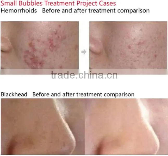 Factory sale dermabrasion peel spa facial machine microdermabrasion facial machine
