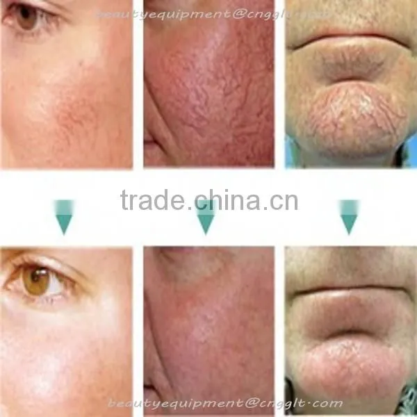 Professional RBS spider vein removal machine with best treatment effect