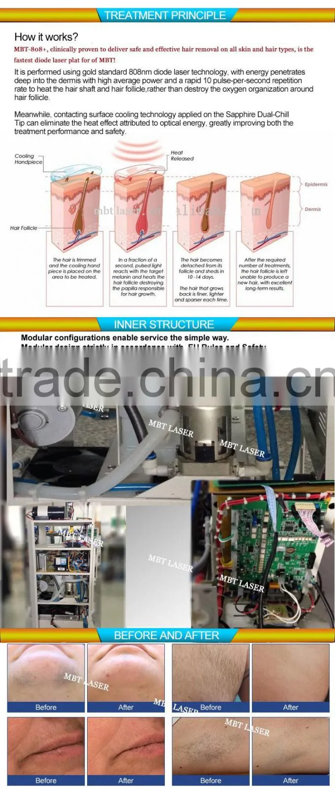 Big discount 808 diode laser 808nm diode laser hair removal equipment with factory price