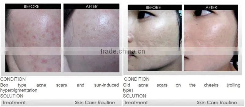 540 derma roller