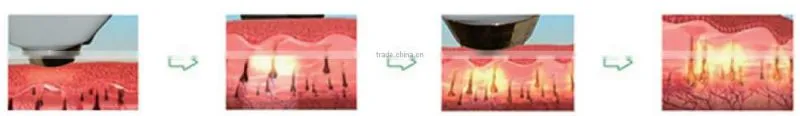808nm Diode Laser Hair Removal Machine For Women , Laser Treatment For Facial Hair