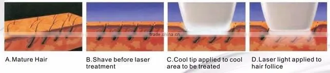 808nm diode laser vertical 808nm hair removal diode laser machine