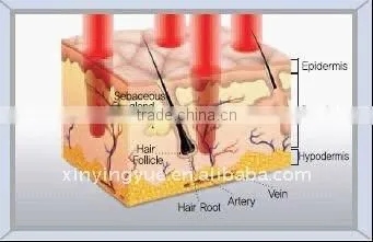 professional fractional co2 laser scar removal