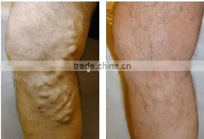 portable Lipolysis Laser Melting fat equipment with 30W 980nm diode laser