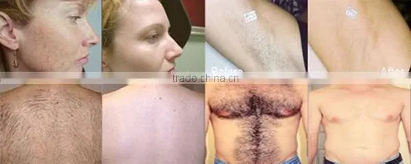 Best Elight IPL RF 3H photo rejuvenation machine