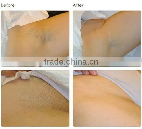 808nm Diode Laser Hair Removal Machine/ laser Depilator Home