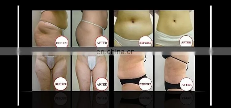 Portable cryo slimming machine cryotherapy equipment crio radiofrecuencia