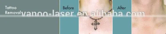 # q switched nd yag laser tattoo removal machine
