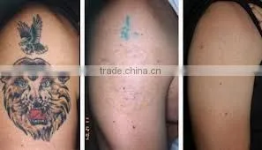 Q Switched nd yag laser tattoo removal machine/nd yag laser with 7 joint articulated arm