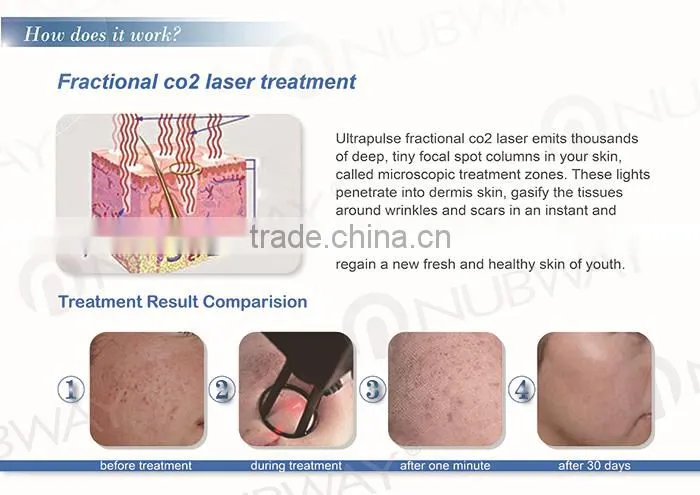 CE Approval !!! laser co2 medico / fractional co2 laser / portable co2 laser