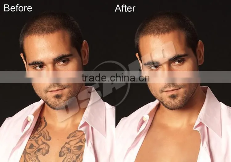 Mini ND YAG Laser Tattoo Removal Machine