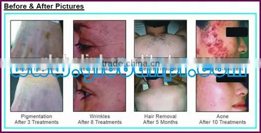 2015 classiacal laser hair removal machines ndyag
