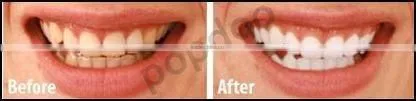 LED Teeth whitening lamp with CE certificate