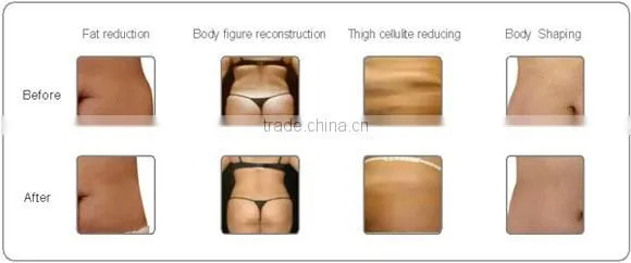 T&B distributor ultrasound cavitation liposculpture CE