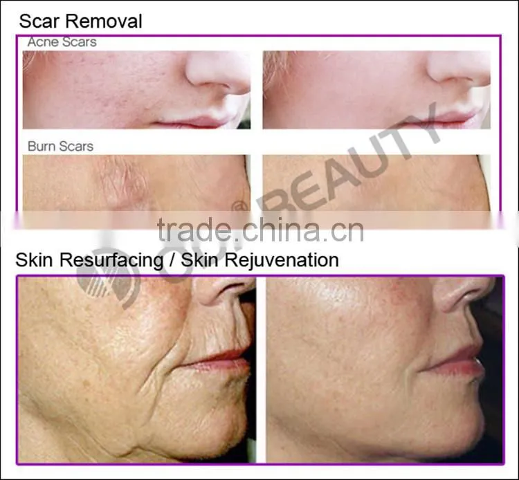 Innovative product medical carbon dioxide co 2 fractional laser skin laser resurfacing