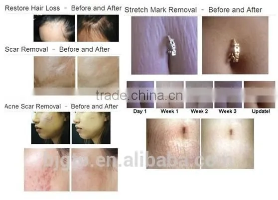 price jumping! 540 needles scar treatment face derma roller