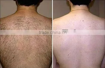 2013 new promotion! stationary hair removal laser yag laser P001