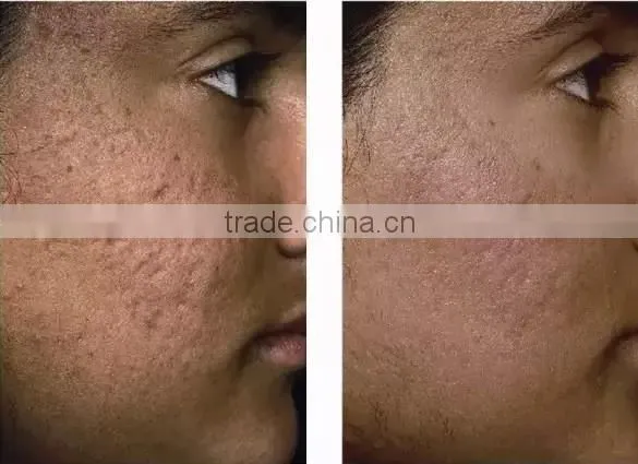 High power co2 laser vaginal rejuvenation treatment beauty vaginal beauty machine