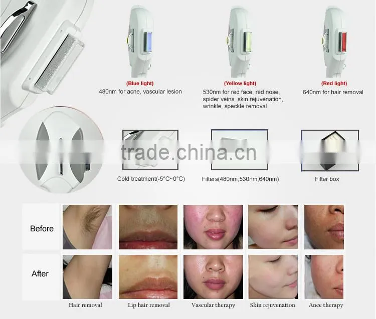 Economy laser epilation system for permanent