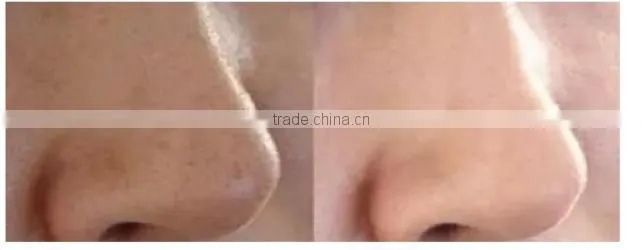 Face Lifting Skin Peeling Facial Bubble Machine Skin Rejuvenation