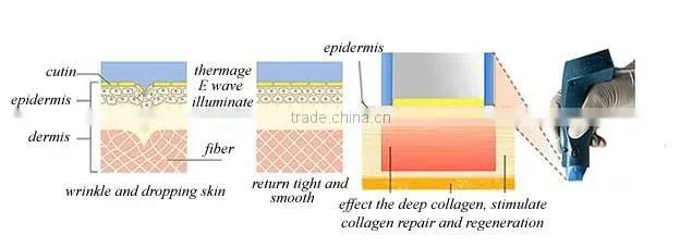 Radio Frequency Fractional rf machine skin tightings machine Best Beauty Salon Machine