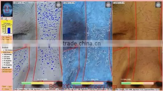 Skin analysis system a-one with pre-set well skin analysis software