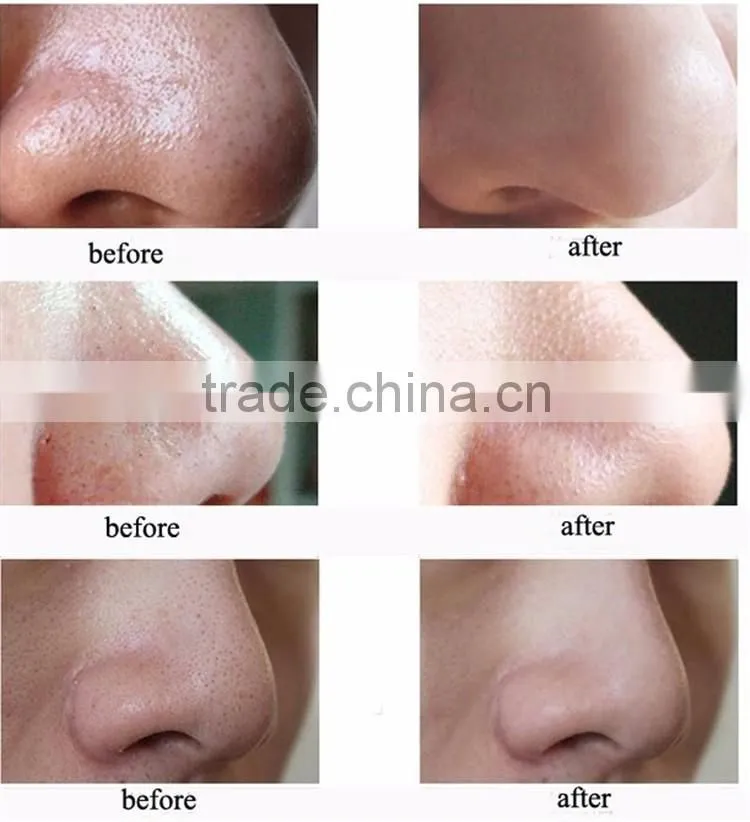 wholesale price nose blackhead remover/blackhead remover