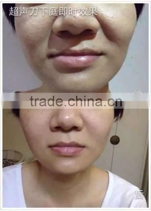 Portable smart 3D anti wrinkle treatment HIFU beauty machine