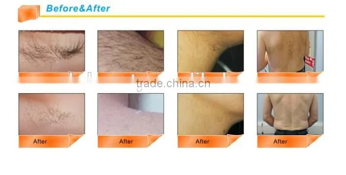 Hot selling Portable SHR IPL Fast Hair Removal 10HZ
