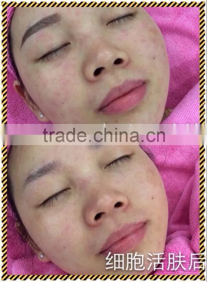 Water oxygen jet peel skin oxigenoterapia hydro dermabrasion water oxygen jet peel machine