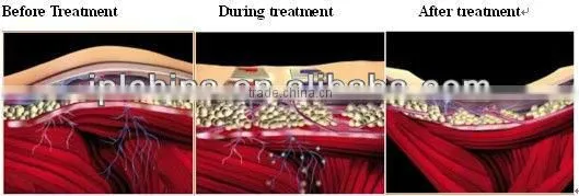 2014 Newly RF Cyclone Bady Shape Skin Care Equipment