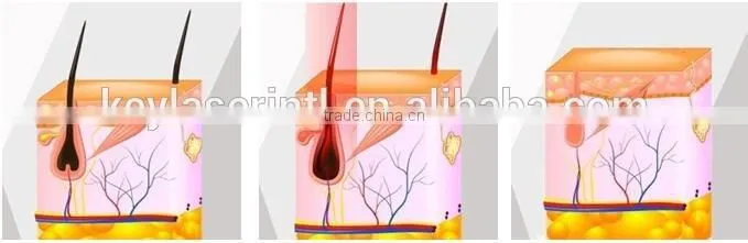 real sapphire crystal shr ipl face treatment home use beauty equipment
