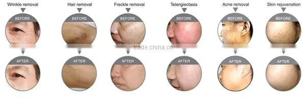 High Quality Innovative Acne Scar Removal Derma Roller