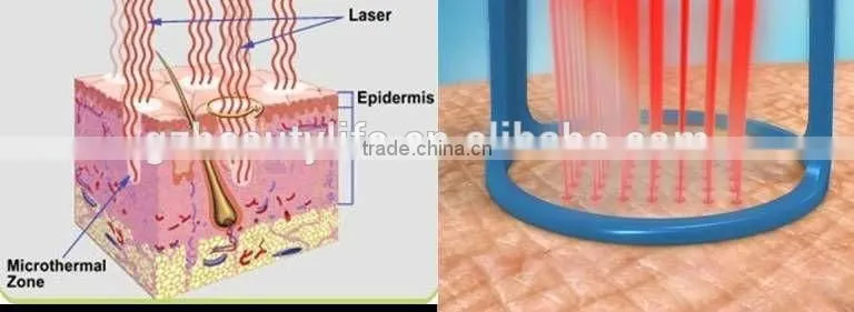 rf co2 fractional laser