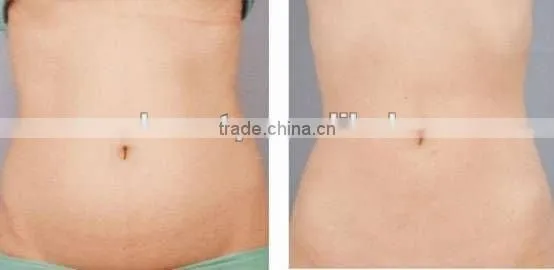 ultrasound liposuction rf tripolar reduce belly equipment F017