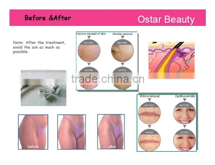 Radiofrecuency portable machines skin lifting skin care beauty equipment RF 03
