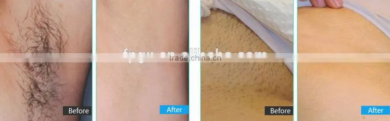 Elight rf+ipl solon use face lift machine for vascular/wrinkle/acne removal